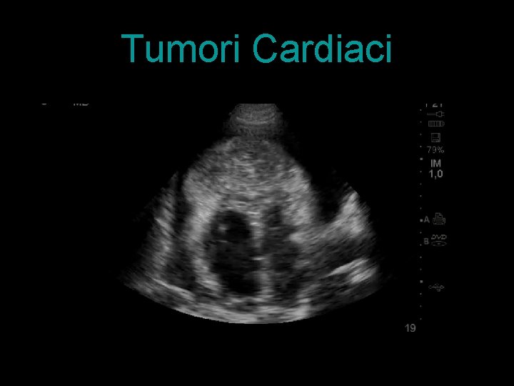 Tumori Cardiaci 