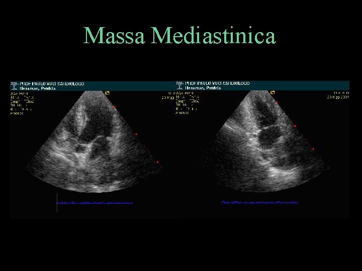 Massa Mediastinica 