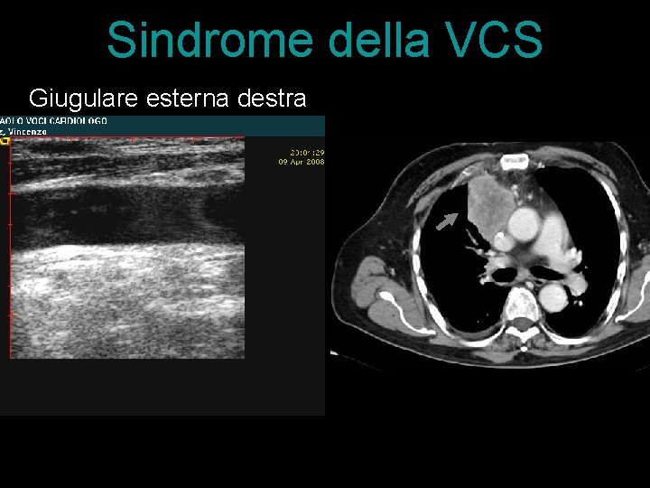 Sindrome della VCS Giugulare esterna destra 