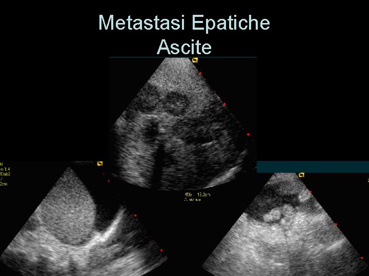 Metastasi Epatiche Ascite 