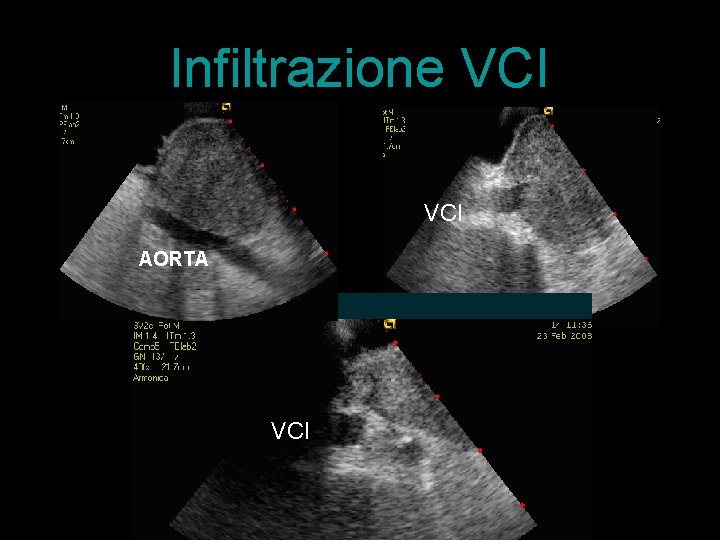 Infiltrazione VCI AORTA Aorta VCI 