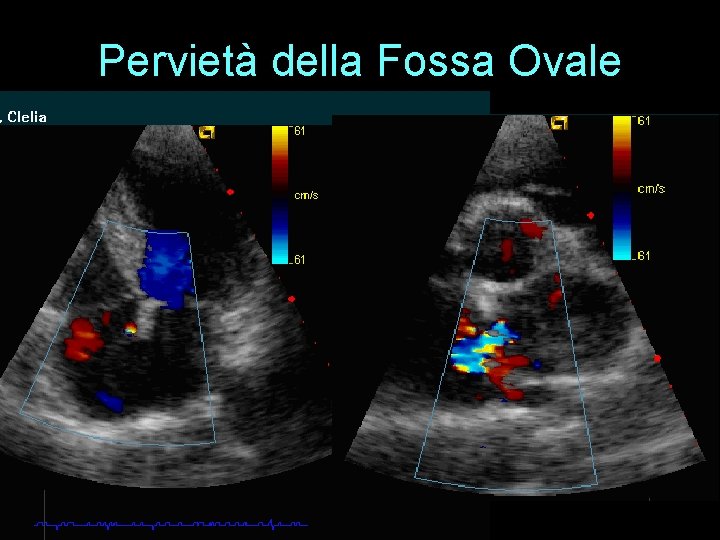 Pervietà della Fossa Ovale 