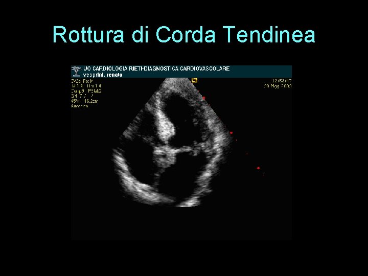 Rottura di Corda Tendinea 