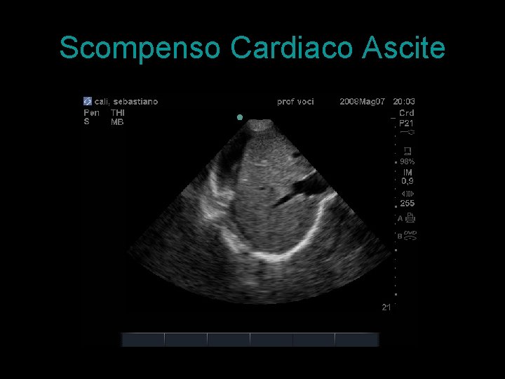 Scompenso Cardiaco Ascite 