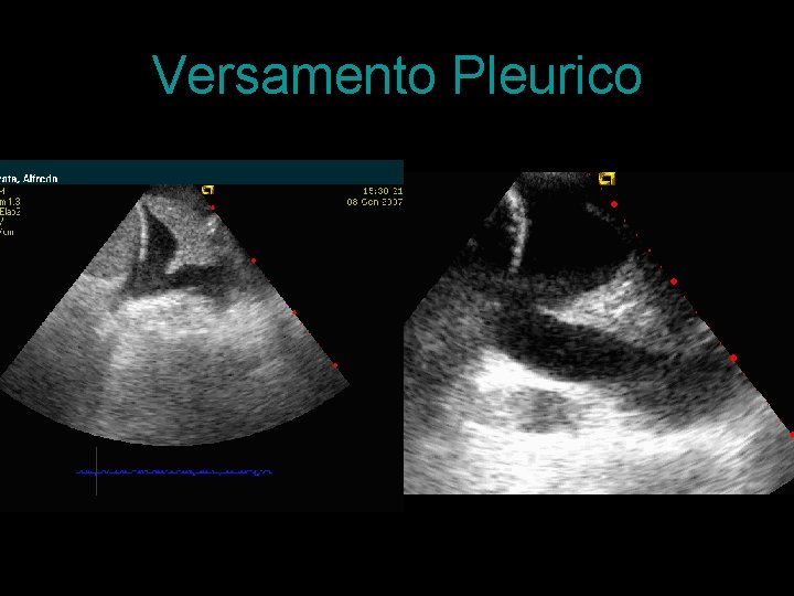 Versamento Pleurico 