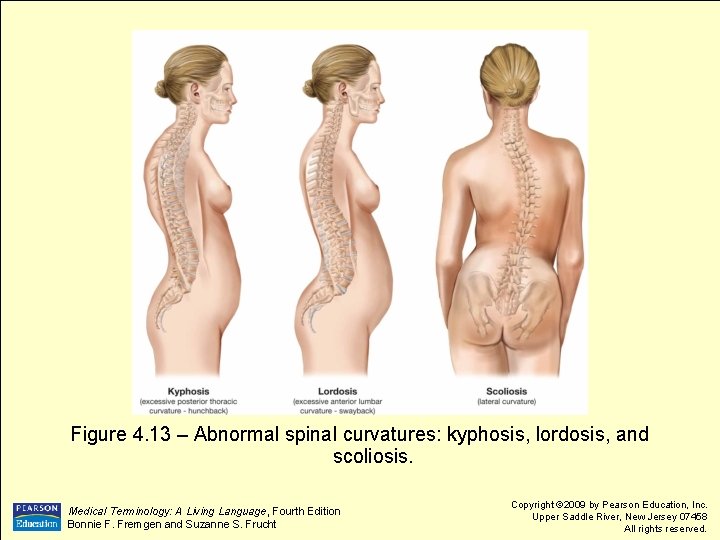 Figure 4. 13 – Abnormal spinal curvatures: kyphosis, lordosis, and scoliosis. Medical Terminology: A