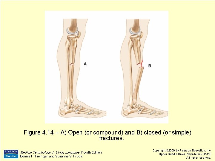 Figure 4. 14 – A) Open (or compound) and B) closed (or simple) fractures.