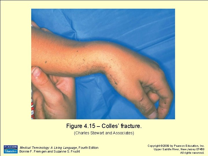 Figure 4. 15 – Colles’ fracture. (Charles Stewart and Associates) Medical Terminology: A Living