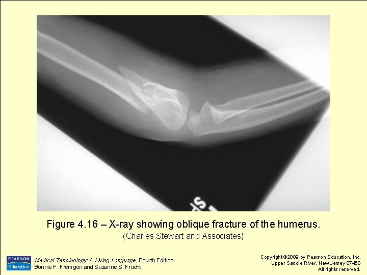 Figure 4. 16 – X-ray showing oblique fracture of the humerus. (Charles Stewart and