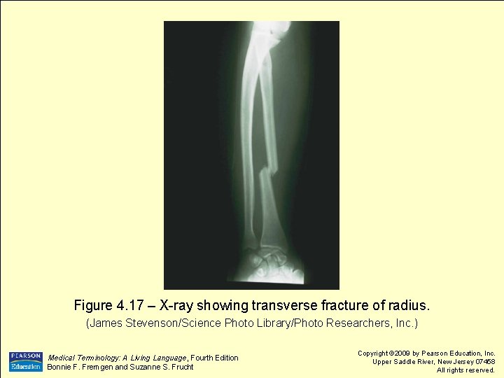 Figure 4. 17 – X-ray showing transverse fracture of radius. (James Stevenson/Science Photo Library/Photo