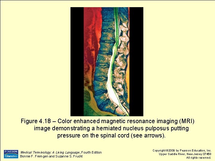 Figure 4. 18 – Color enhanced magnetic resonance imaging (MRI) image demonstrating a herniated