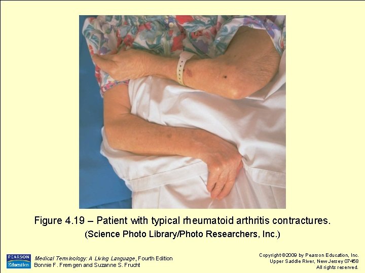 Figure 4. 19 – Patient with typical rheumatoid arthritis contractures. (Science Photo Library/Photo Researchers,