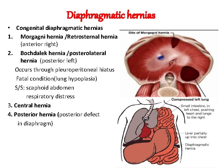 Diaphragmatic hernias • Congenital diaphragmatic hernias 1. Morgagni hernia /Retrosternal hernia (anterior right) 2.