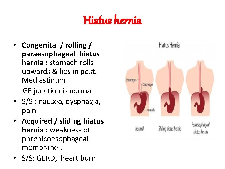 Hiatus hernia • Congenital / rolling / paraesophageal hiatus hernia : stomach rolls upwards