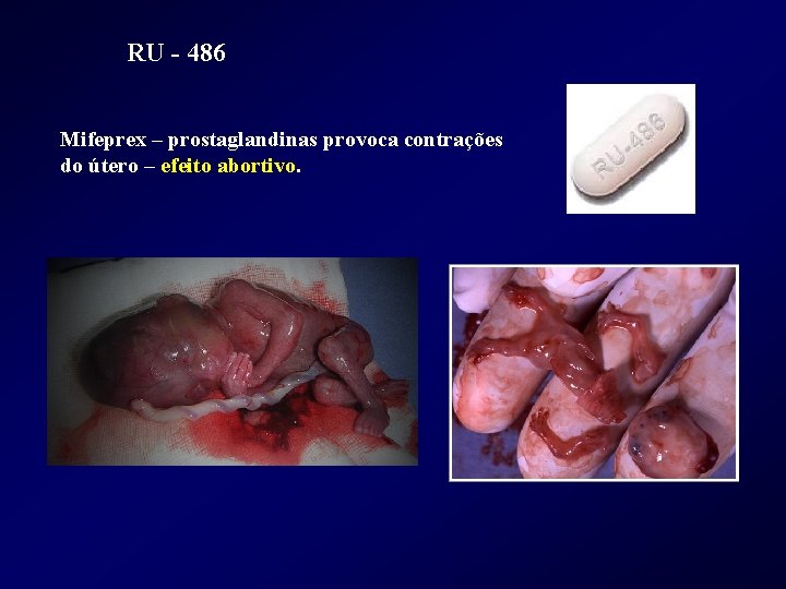 RU - 486 Mifeprex – prostaglandinas provoca contrações do útero – efeito abortivo. 