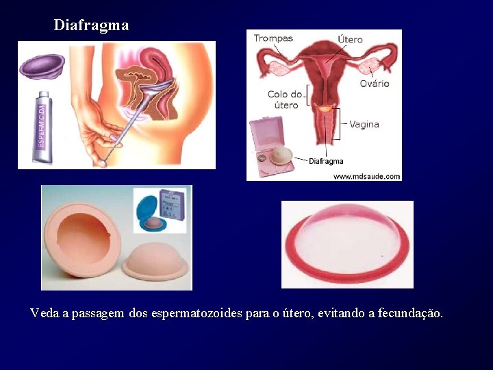 Diafragma Veda a passagem dos espermatozoides para o útero, evitando a fecundação. 