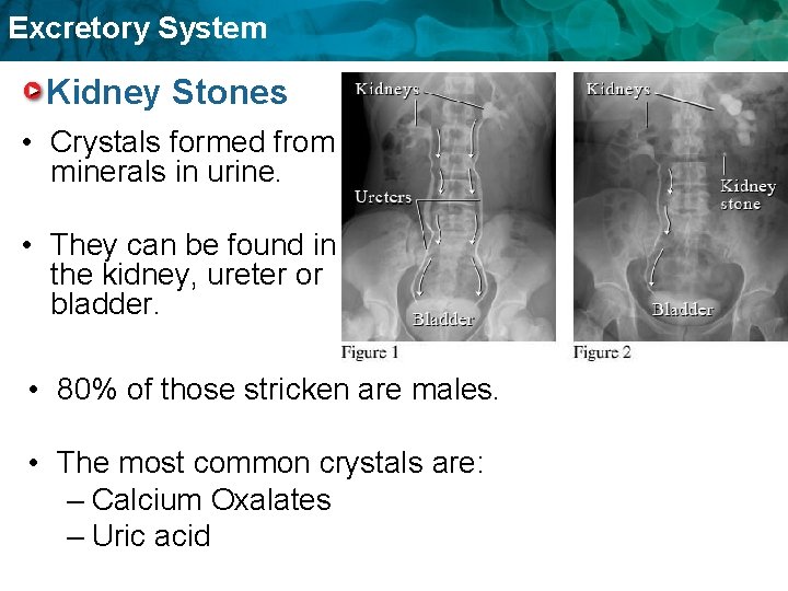 Excretory System Kidney Stones • Crystals formed from minerals in urine. • They can