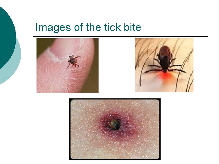 Images of the tick bite 