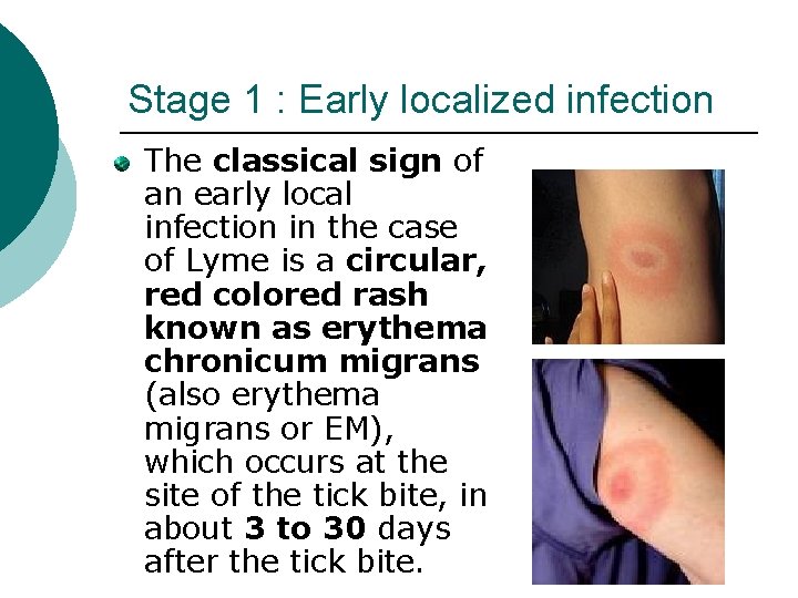 Stage 1 : Early localized infection The classical sign of an early local infection Stage 1 : Early localized infection The classical sign of an early local infection