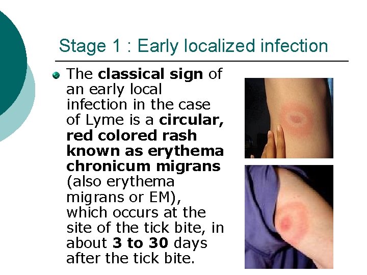 Stage 1 : Early localized infection The classical sign of an early local infection