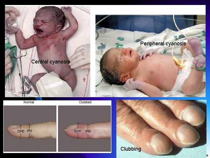 Peripheral cyanosis Central cyanosis Clubbing Peripheral cyanosis Central cyanosis Clubbing