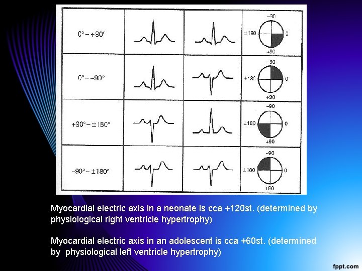 Myocardial electric axis in a neonate is cca +120 st. (determined by physiological right