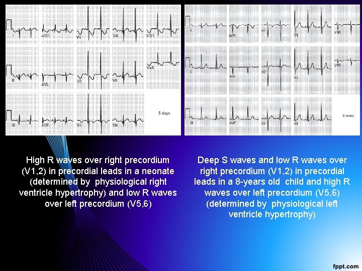 High R waves over right precordium (V 1, 2) in precordial leads in a