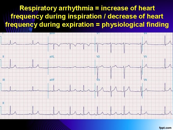 Respiratory arrhythmia = increase of heart frequency during inspiration / decrease of heart frequency
