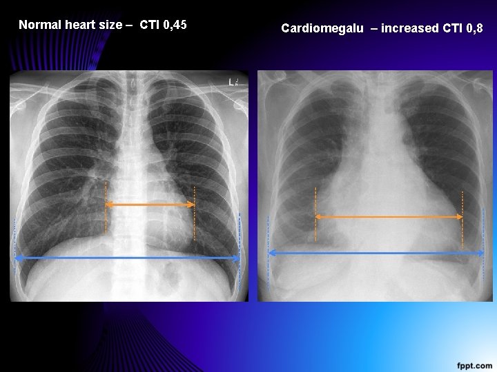 Normal heart size – CTI 0, 45 Cardiomegalu – increased CTI 0, 8 
