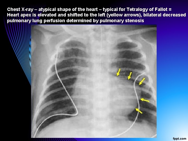 Chest X-ray – atypical shape of the heart – typical for Tetralogy of Fallot