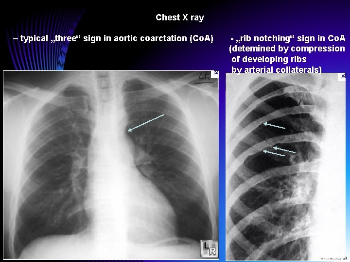 Chest X ray – typical „three“ sign in aortic coarctation (Co. A) - „rib