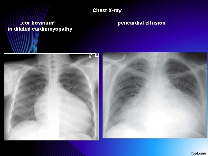 Chest X-ray „cor bovinum“ in dilated cardiomyopathy pericardial effusion 