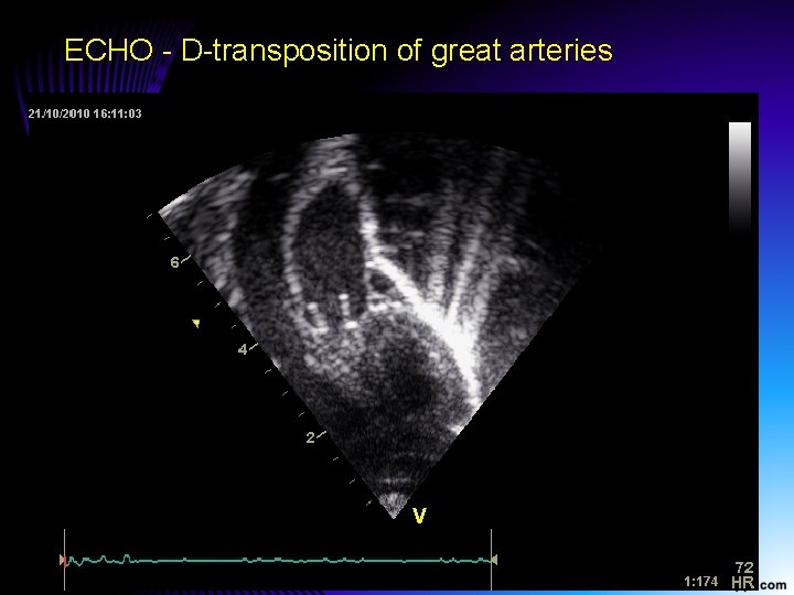 ECHO - D-transposition of great arteries 