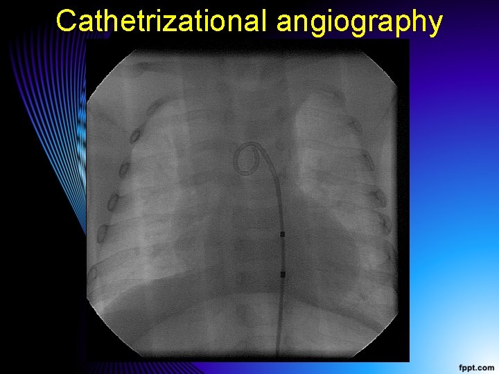 Cathetrizational angiography 