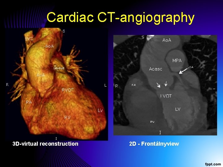 Cardiac CT-angiography 3 D-virtual reconstruction 2 D - Frontálnyview 