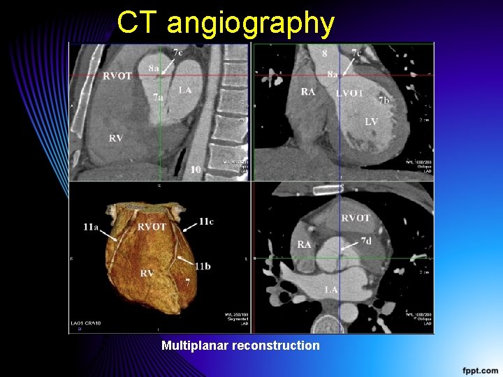 CT angiography Multiplanar reconstruction 