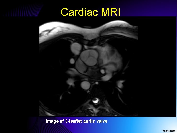 Cardiac MRI Image of 3 -leaflet aortic valve 
