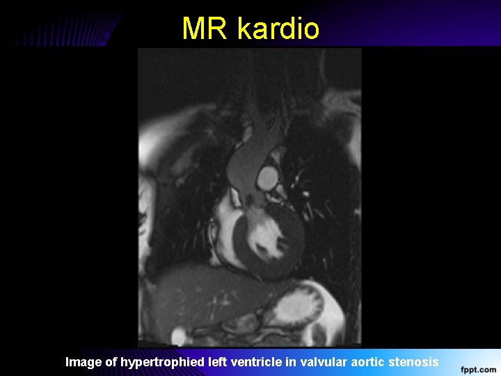 MR kardio Image of hypertrophied left ventricle in valvular aortic stenosis 