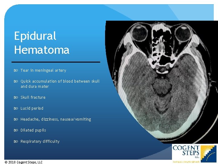 Epidural Hematoma Tear in meningeal artery Quick accumulation of blood between skull and dura Epidural Hematoma Tear in meningeal artery Quick accumulation of blood between skull and dura
