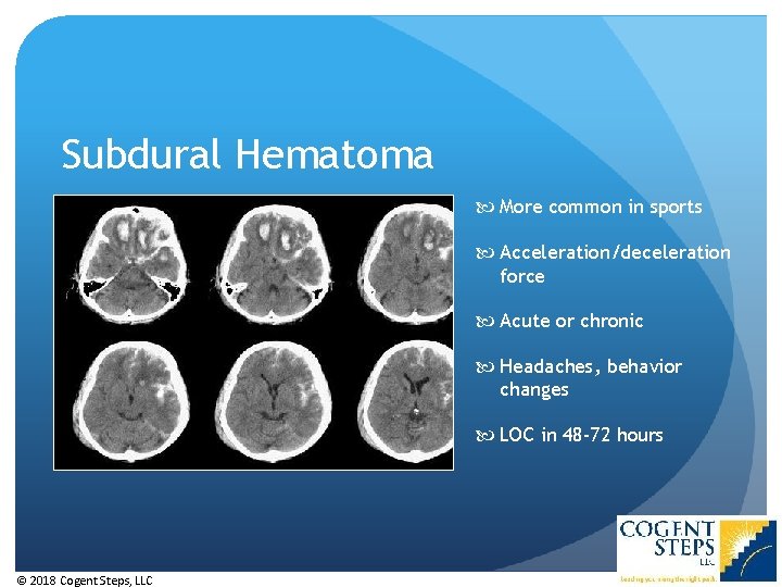 Subdural Hematoma More common in sports Acceleration/deceleration force Acute or chronic Headaches, behavior changes Subdural Hematoma More common in sports Acceleration/deceleration force Acute or chronic Headaches, behavior changes