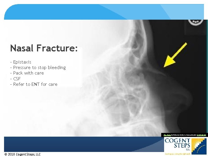 Nasal Fracture: - Epistaxis Pressure to stop bleeding Pack with care CSF Refer to Nasal Fracture: - Epistaxis Pressure to stop bleeding Pack with care CSF Refer to