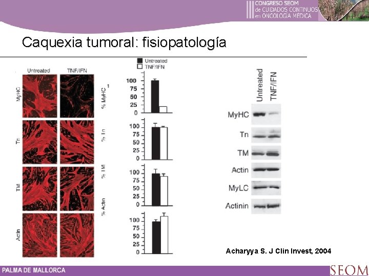 Caquexia tumoral: fisiopatología Acharyya S. J Clin Invest, 2004 