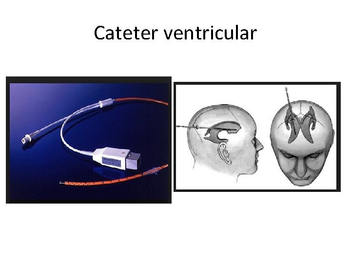 Cateter ventricular 