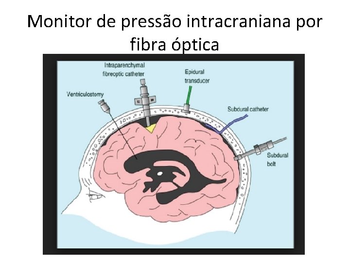 Monitor de pressão intracraniana por fibra óptica 
