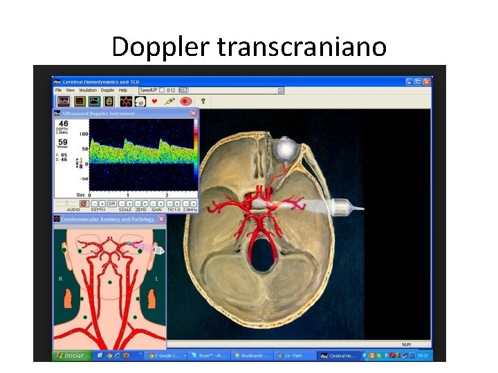 Doppler transcraniano 