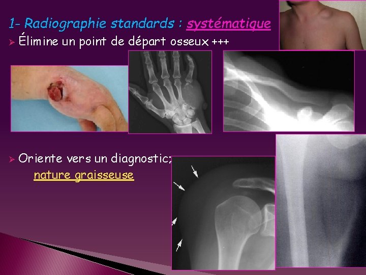 1 - Radiographie standards : systématique Ø Ø Élimine un point de départ osseux