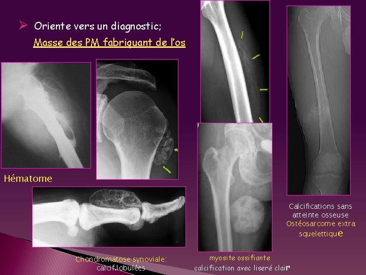 Ø Oriente vers un diagnostic; Masse des PM fabriquant de l’os Hématome Calcifications sans