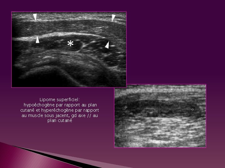Lipome superficiel: hypoéchogène par rapport au plan cutané et hyperéchogène par rapport au muscle