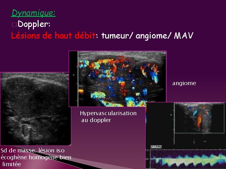 Dynamique: � Doppler: Lésions de haut débit: tumeur/ angiome/ MAV angiome Hypervascularisation au doppler