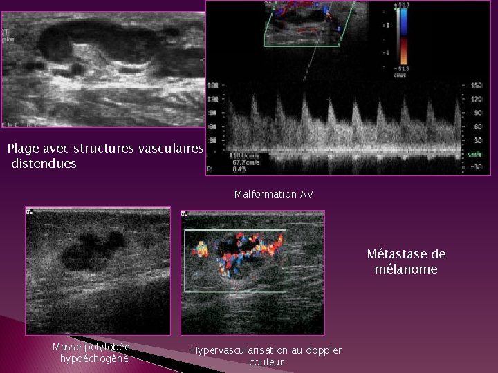 Plage avec structures vasculaires distendues Malformation AV Métastase de mélanome Masse polylobée hypoéchogène Hypervascularisation